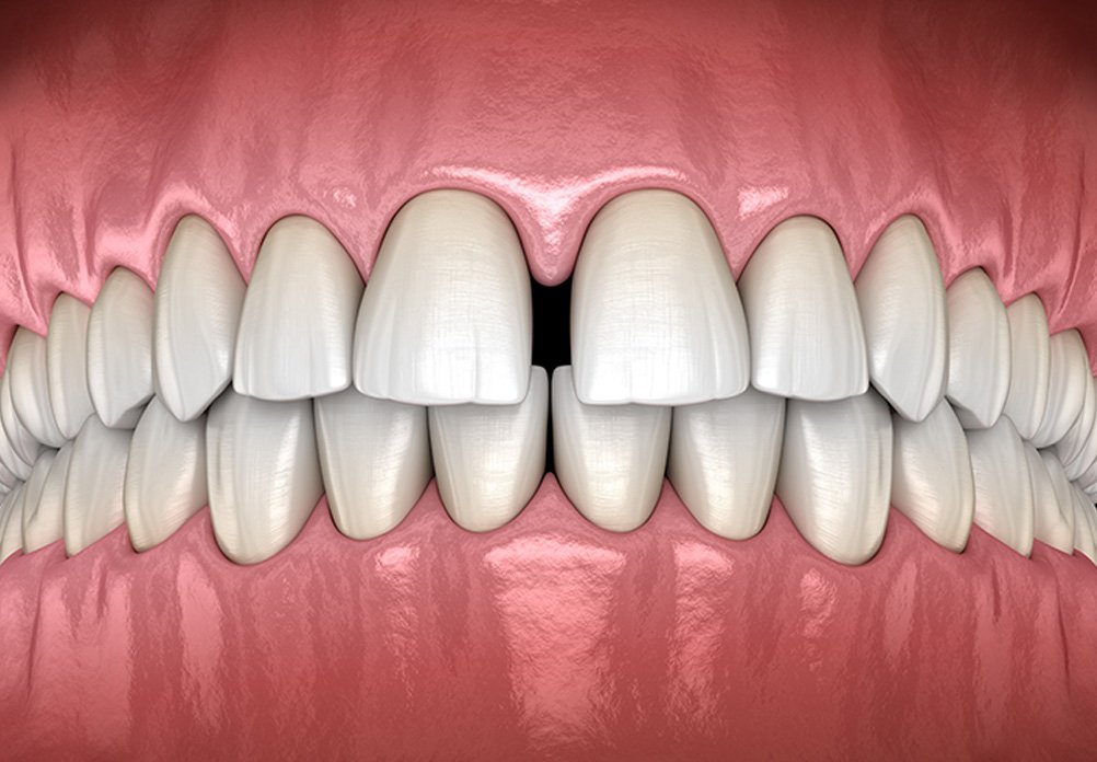 Separación excesiva entre los dientes