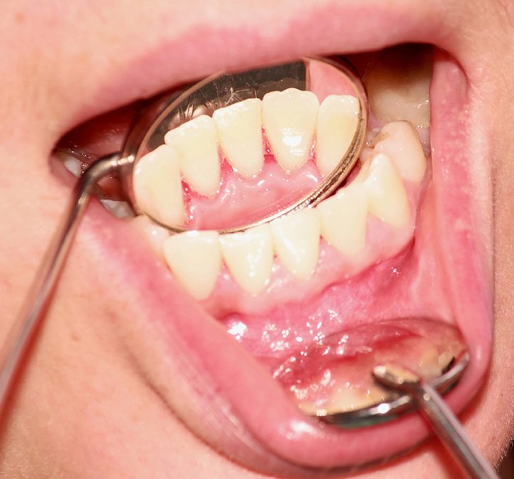 Tratamientos periodontales
