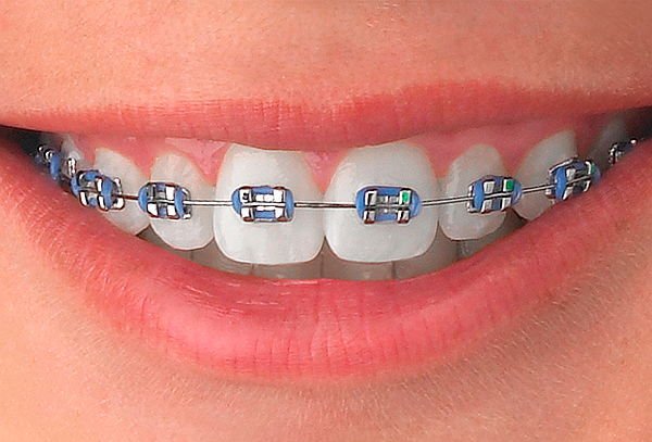 Consejos para solucionar problemas con tus brackets.